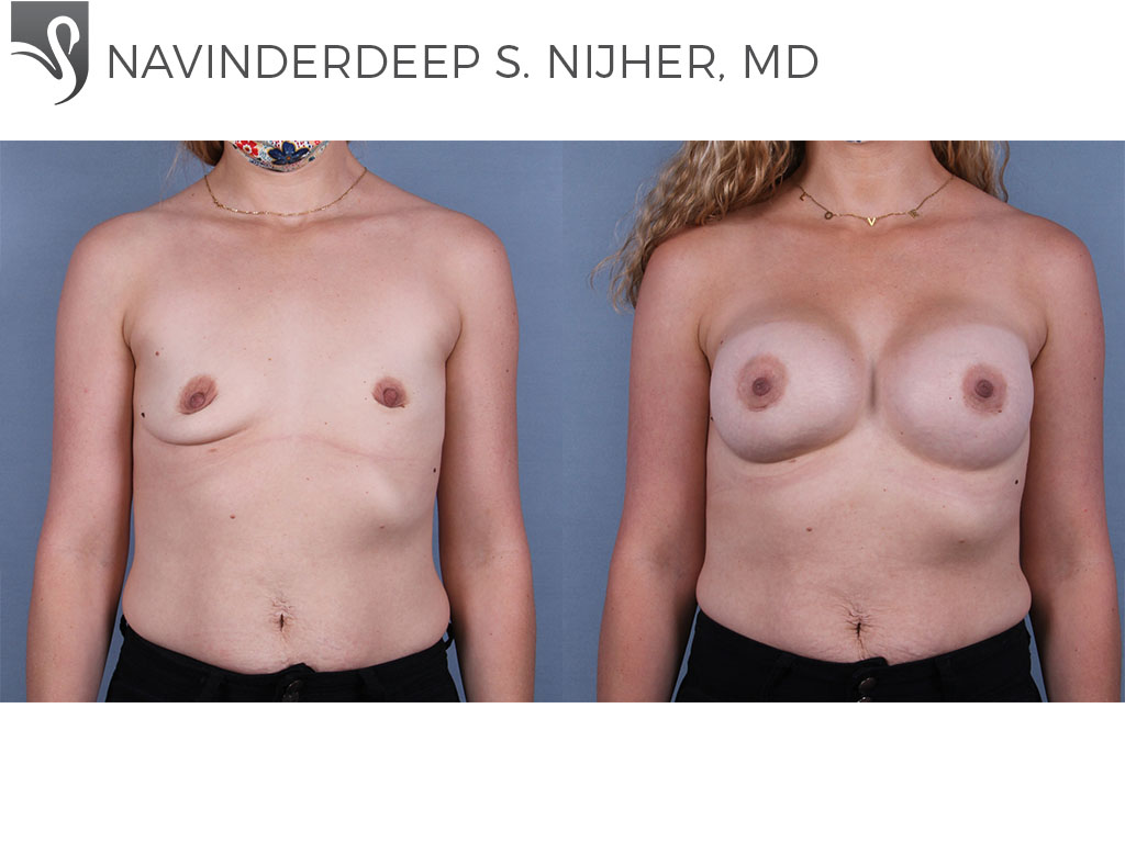 Before and After Image: Breast Augmentation Case #71458 - front