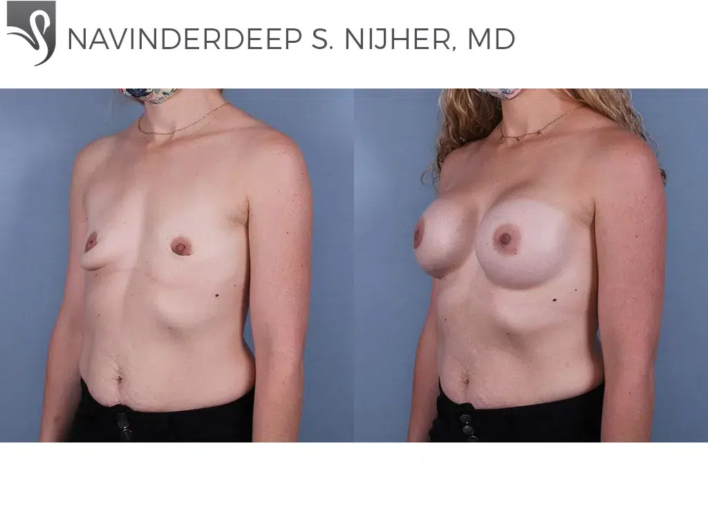 Before and After Image: Breast Augmentation Case #71458 - left-front-oblique