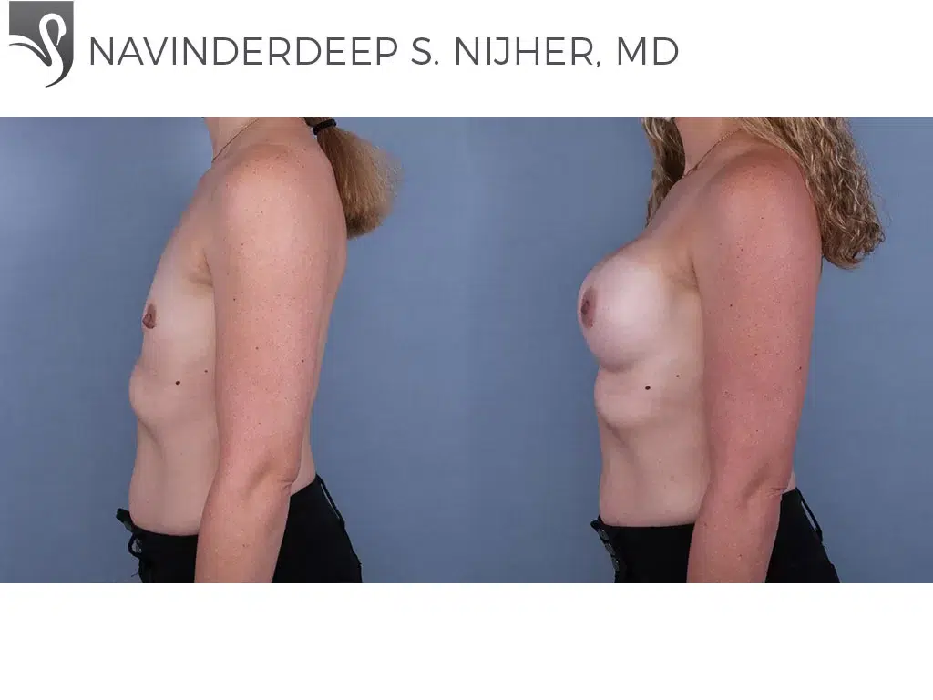 Before and After Image: Breast Augmentation Case #71458 - left-side
