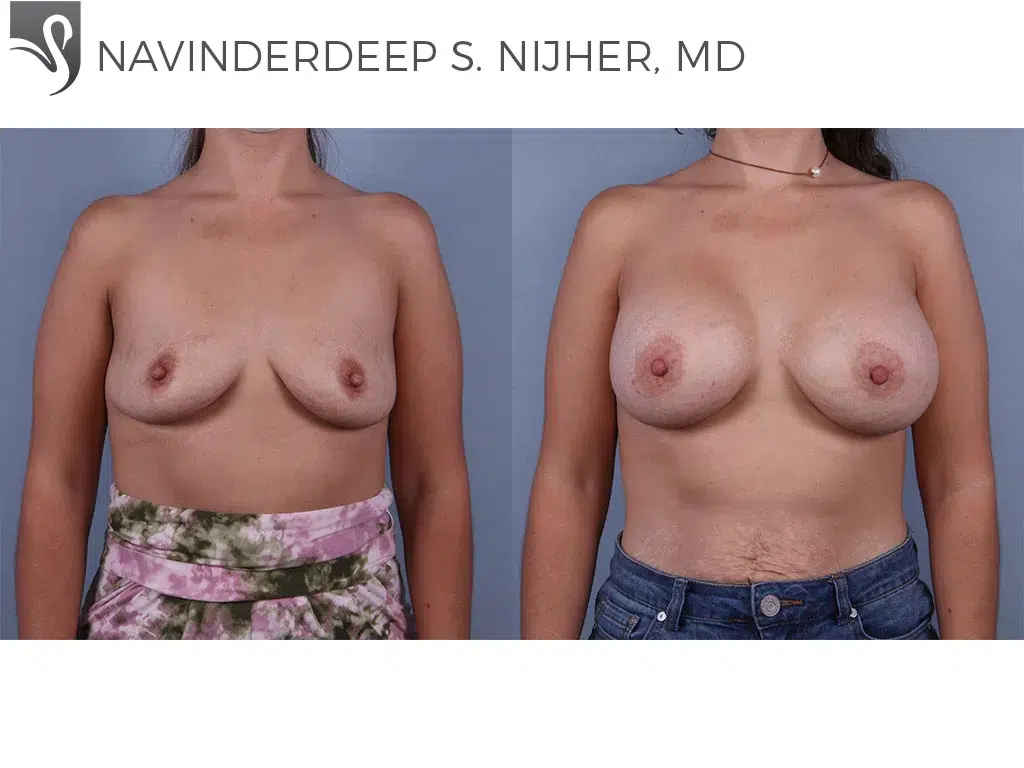 Before and After Image: Breast Augmentation Case #71484 - front