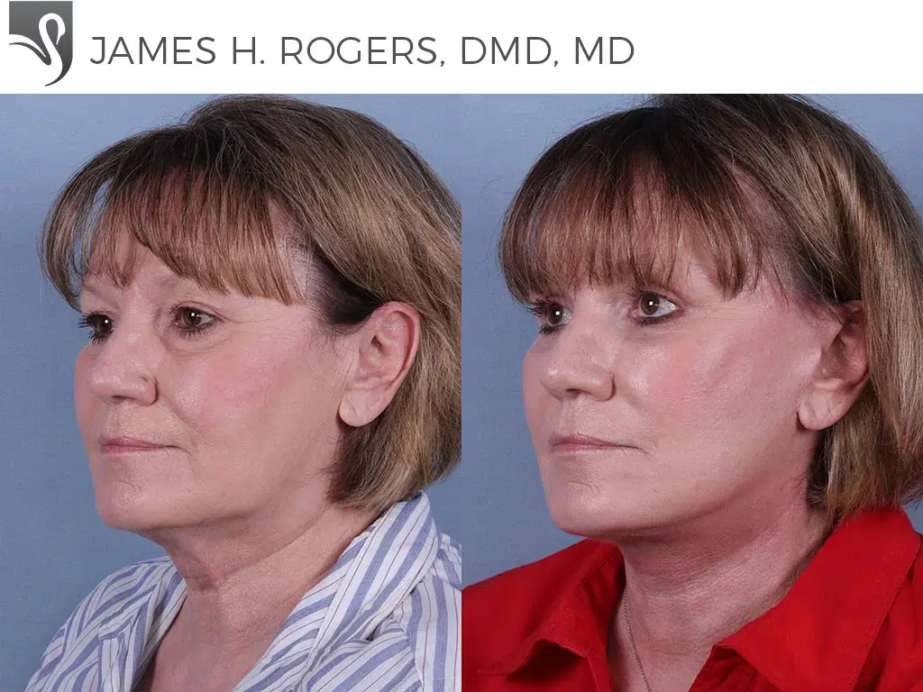 Before and After Image: Face Lift Case #71545 - left-front-oblique