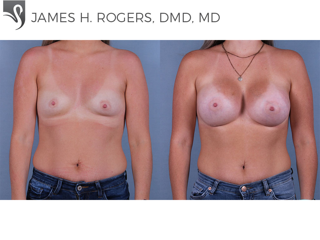 Before and After Image: Breast Augmentation Case #71560 - front