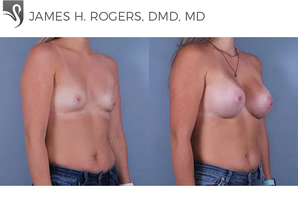 Before and After Image: Breast Augmentation Case #71560 - right-front-oblique