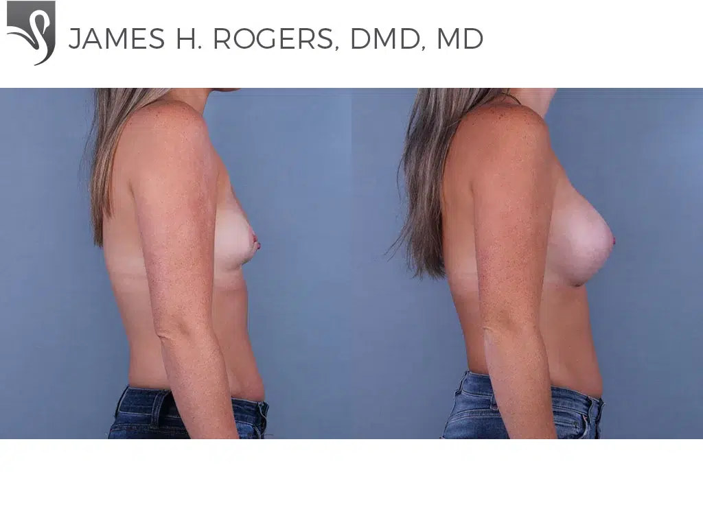 Before and After Image: Breast Augmentation Case #71560 - right-side