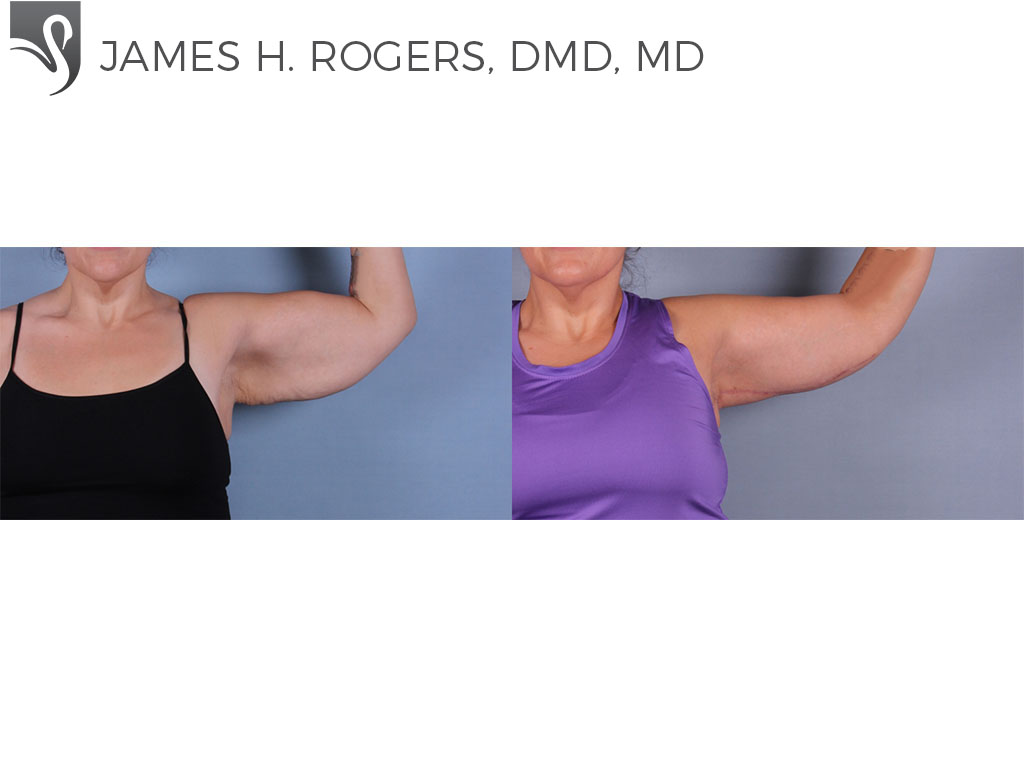 Before and After Image: Arm Lift Case #71583