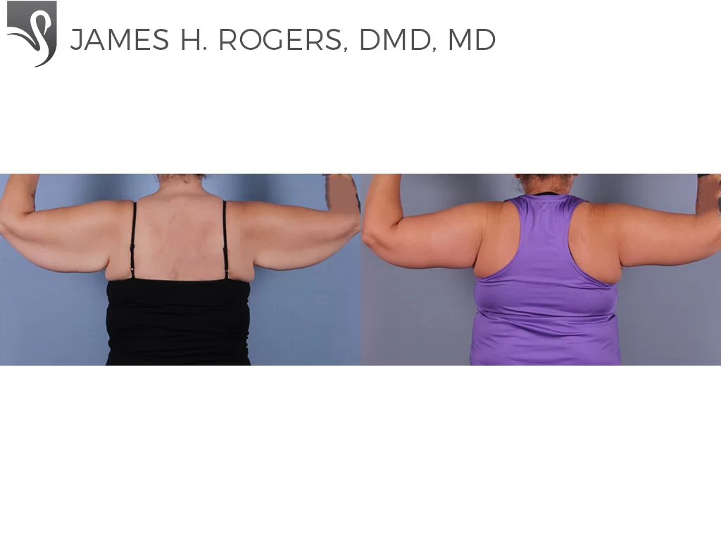 Before and After Image: Arm Lift Case #71583 - back
