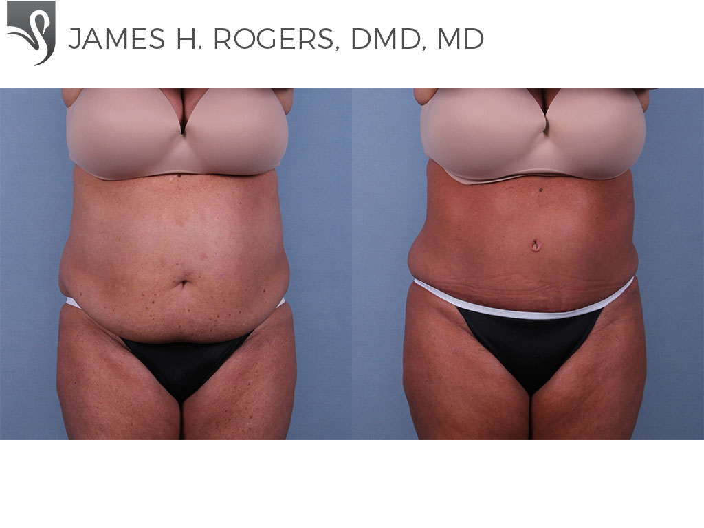 Before and After Image: Abdominoplasty (Tummy Tuck) Case #71640