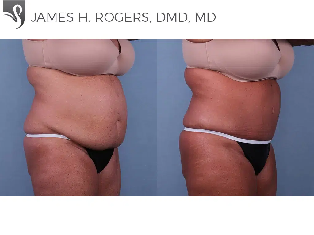 Before and After Image: Abdominoplasty (Tummy Tuck) Case #71640 - right-front-oblique