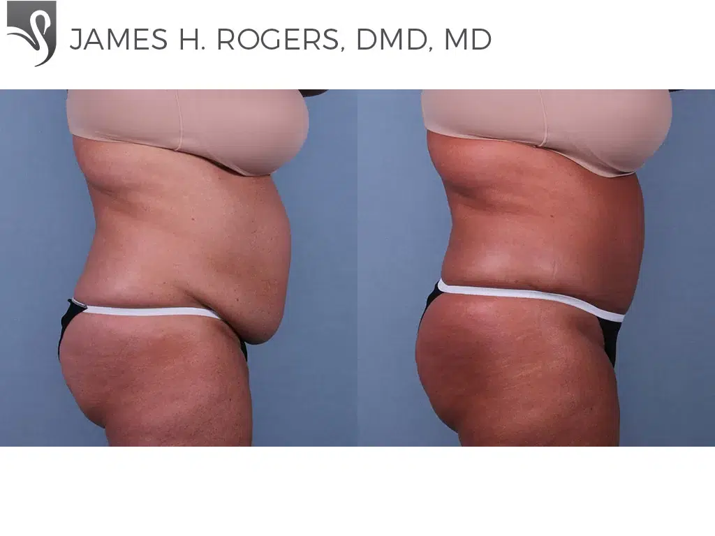 Before and After Image: Abdominoplasty (Tummy Tuck) Case #71640 - right-side