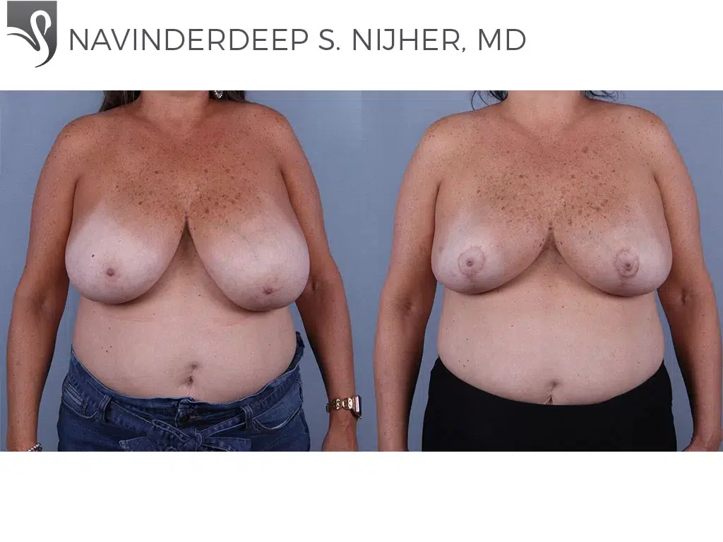 Before and After Image: Female Breast Reduction Case #71667 - front