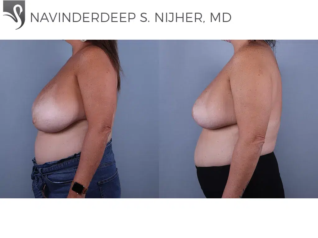 Before and After Image: Female Breast Reduction Case #71667 - left-side