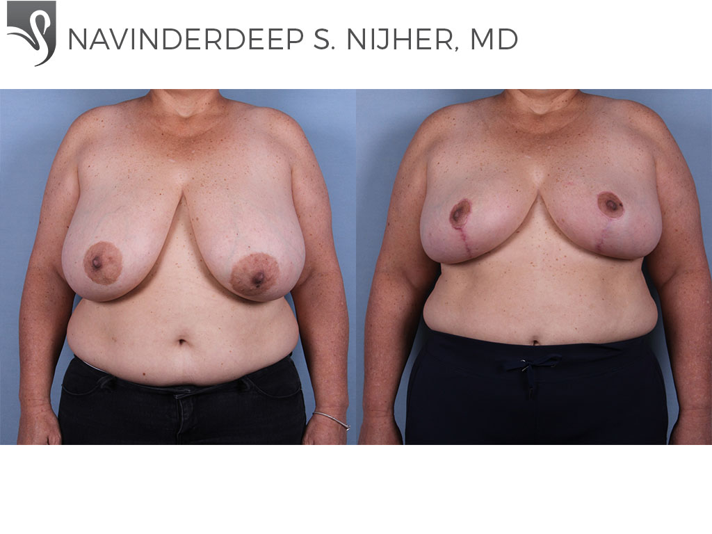 Before and After Image: Female Breast Reduction Case #71704 - front