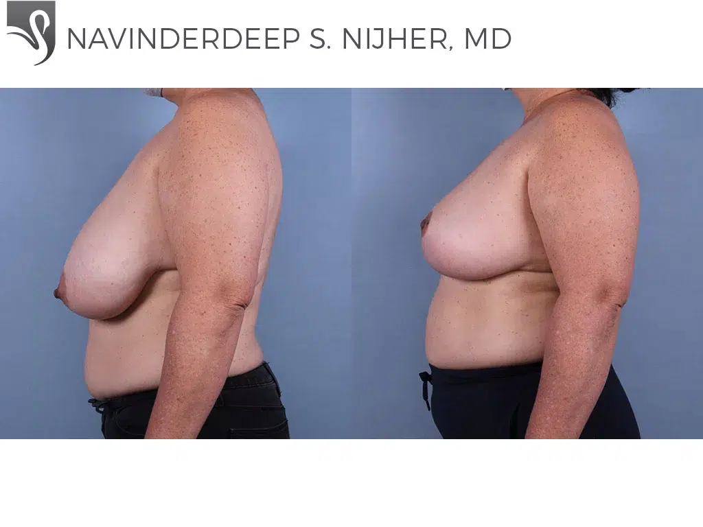 Before and After Image: Female Breast Reduction Case #71704 - left-side