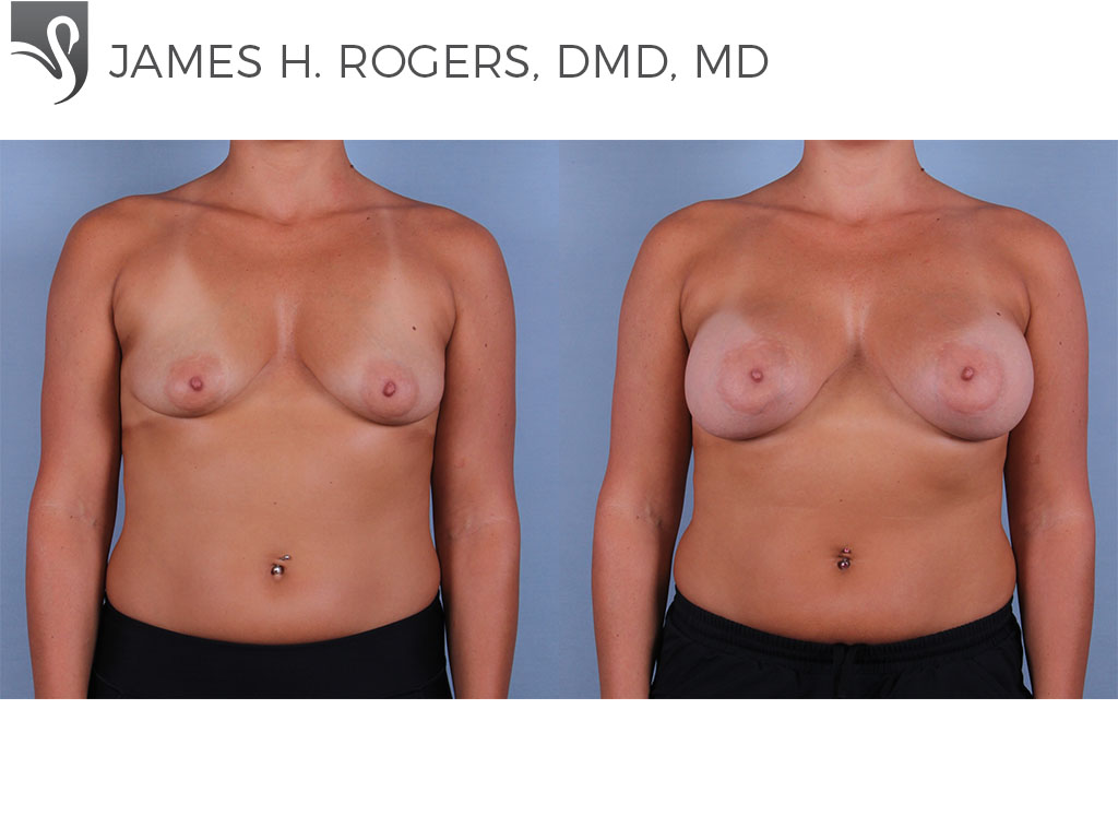 Before and After Image: Breast Augmentation Case #71928 - front