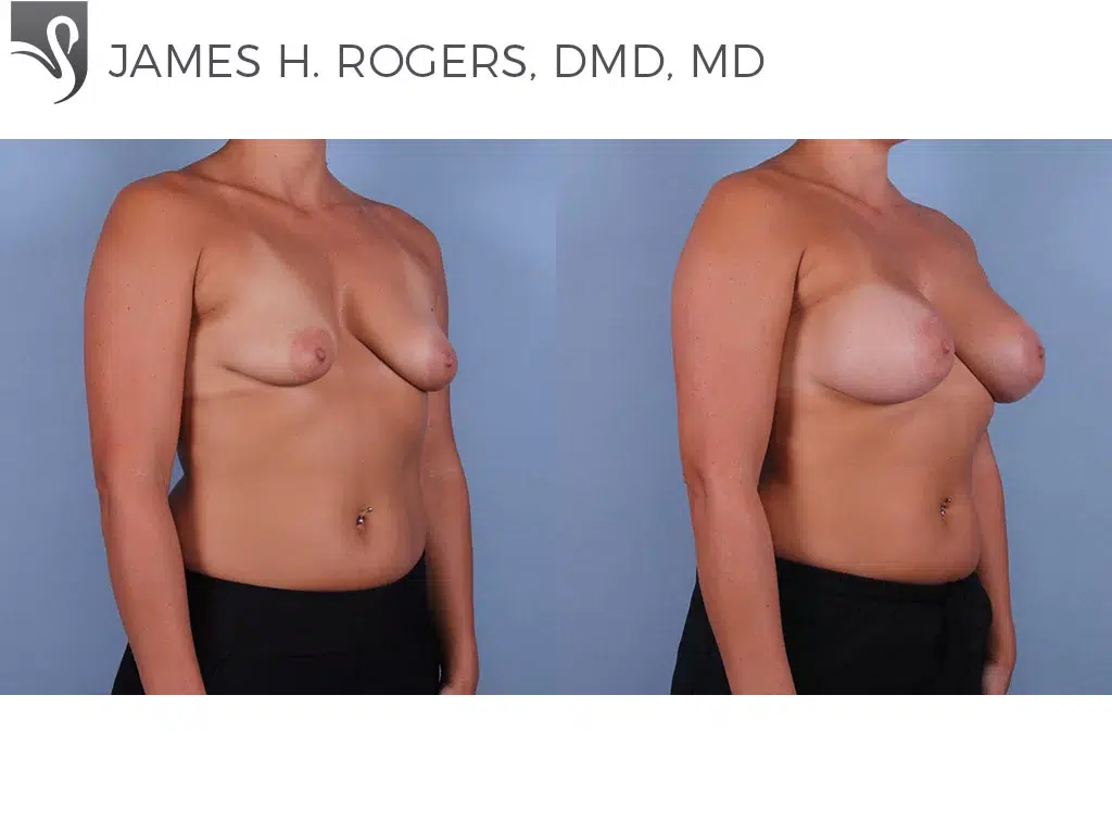 Before and After Image: Breast Augmentation Case #71928 - right-front-oblique