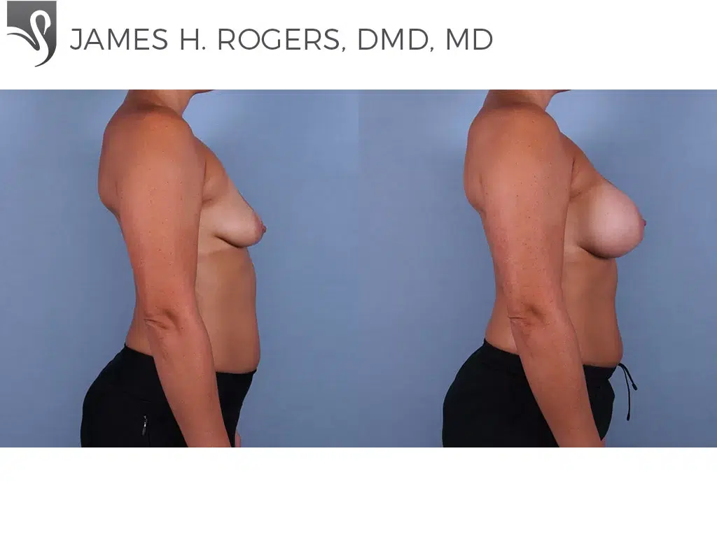 Before and After Image: Breast Augmentation Case #71928 - right-side