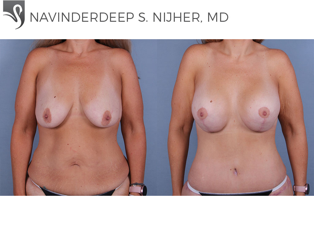 Before and After Image: Breast Lift (Mastopexy) Case #71956 - front
