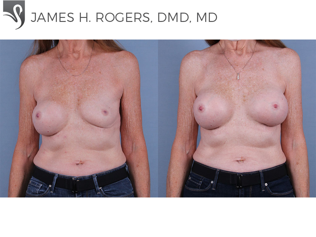 Before and After Image: Breast Revisions Case #72226 - front