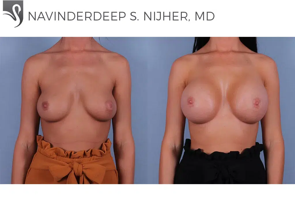 Before and After Image: Breast Augmentation Case #72255