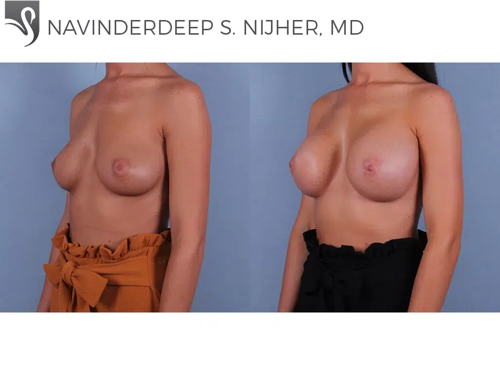 Before and After Image: Breast Augmentation Case #72255 - left-front-oblique