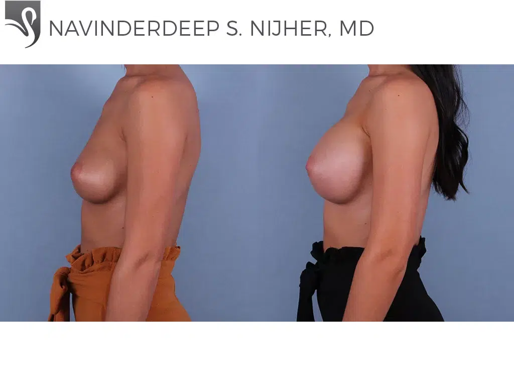 Before and After Image: Breast Augmentation Case #72255 - left-side