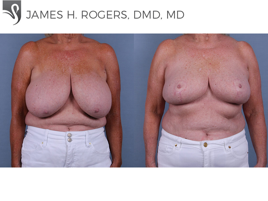Before and After Image: Female Breast Reduction Case #72270