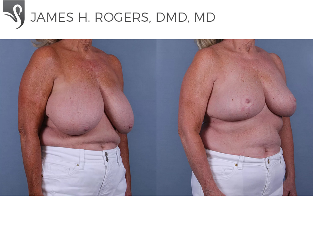 Before and After Image: Female Breast Reduction Case #72270 - right-front-oblique