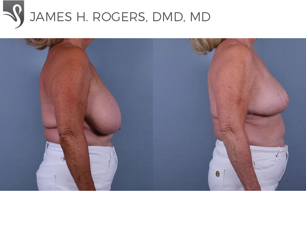 Before and After Image: Female Breast Reduction Case #72270 - right-side