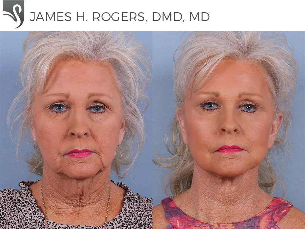 Before and After Image: Face Lift Case #72270 - front