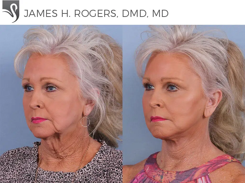 Before and After Image: Face Lift Case #72270 - left-front-oblique