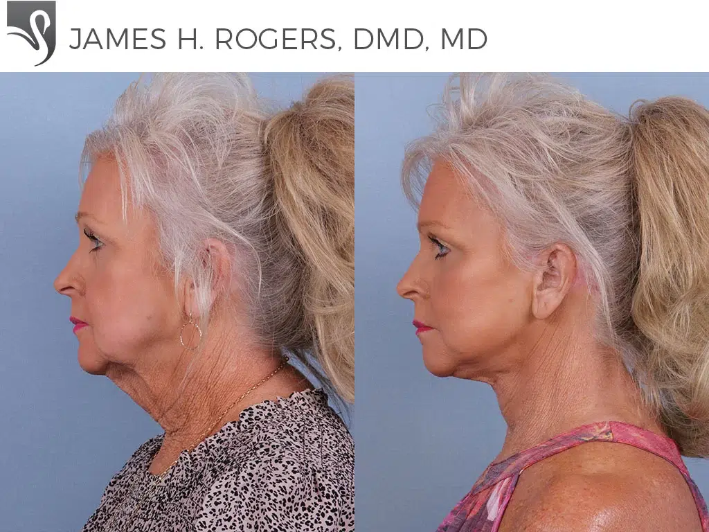 Before and After Image: Face Lift Case #72270 - left-side