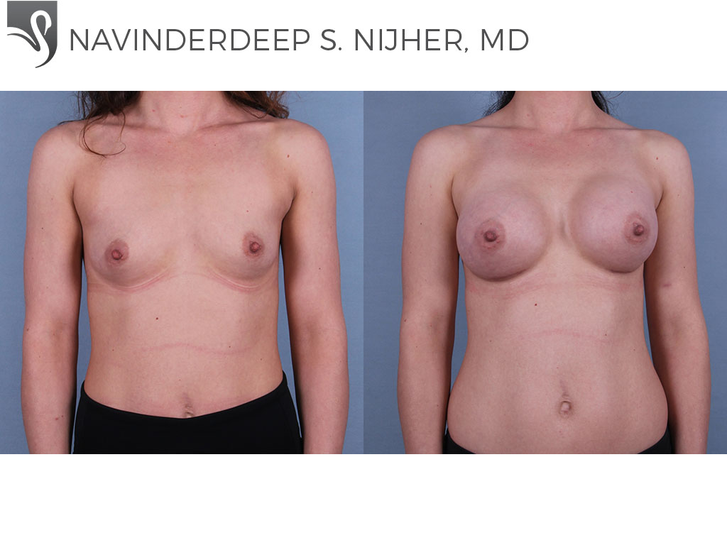 Before and After Image: Breast Augmentation Case #72771 - front