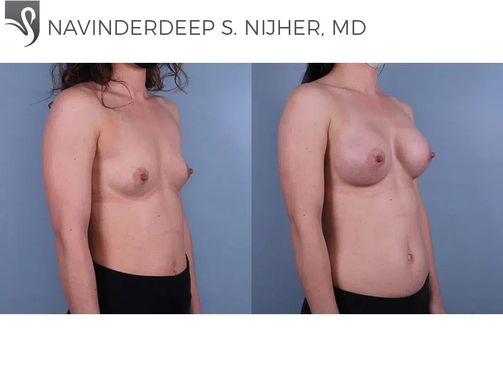 Before and After Image: Breast Augmentation Case #72771 - right-front-oblique