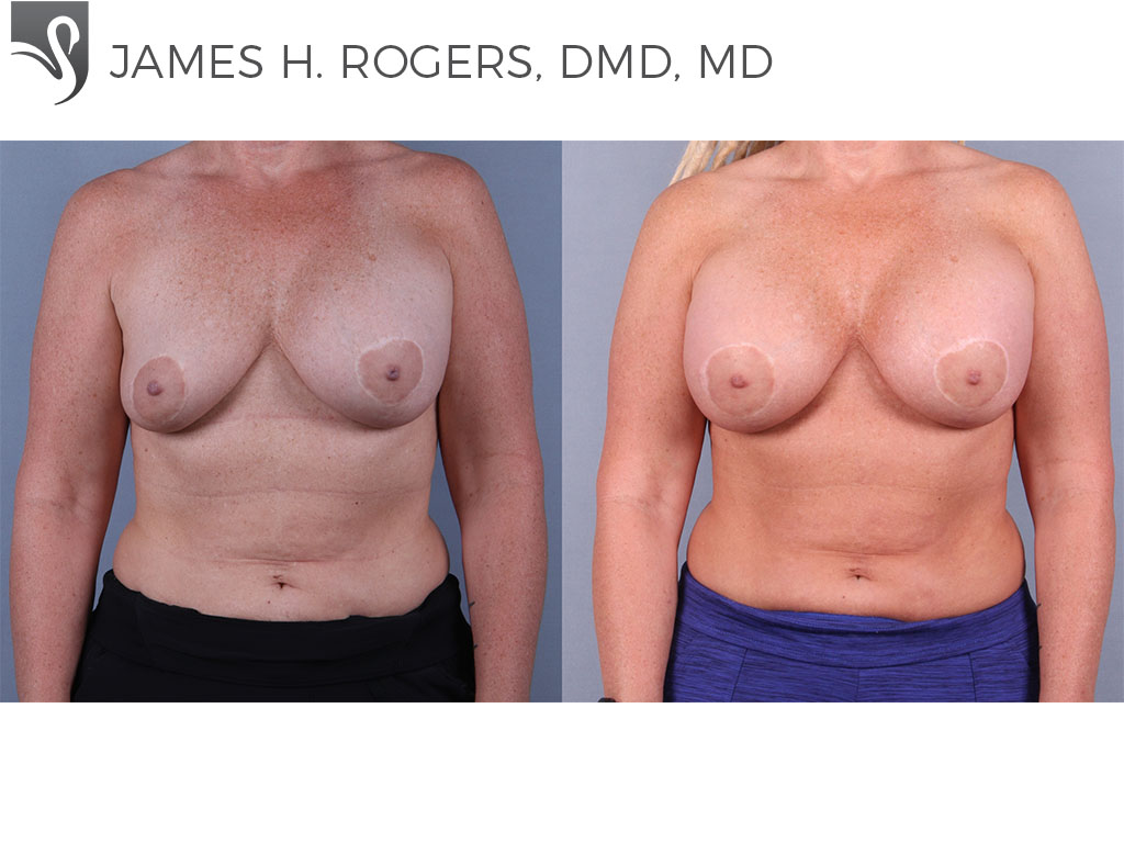 Before and After Image: Breast Revisions Case #72941 - front