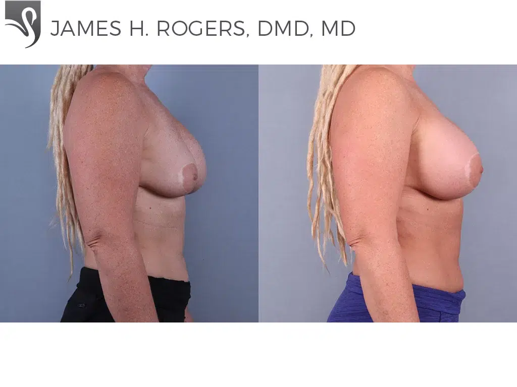 Before and After Image: Breast Revisions Case #72941 - right-side