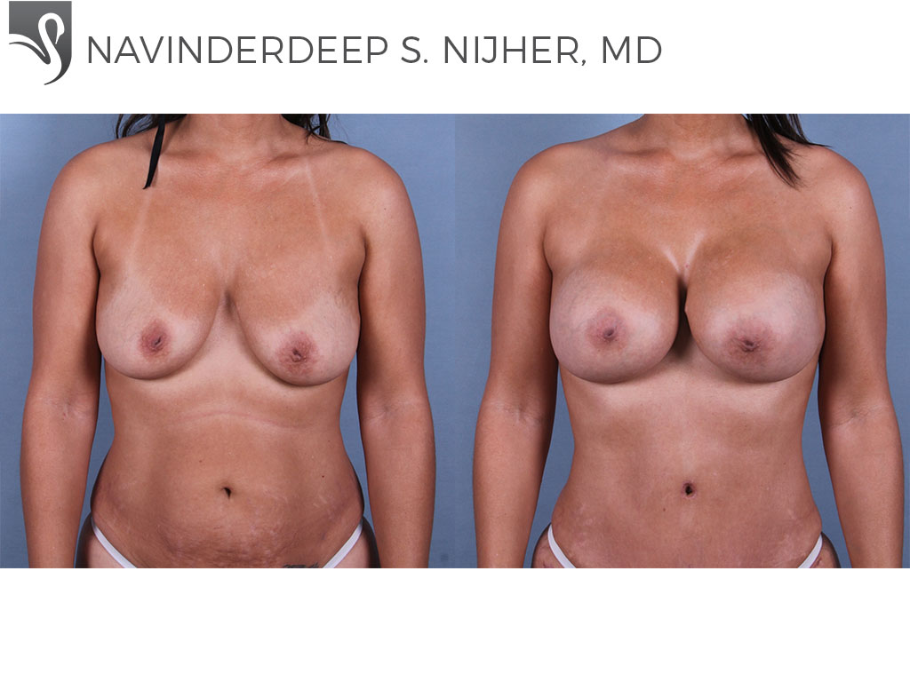 Before and After Image: Breast Augmentation Case #72961 - front