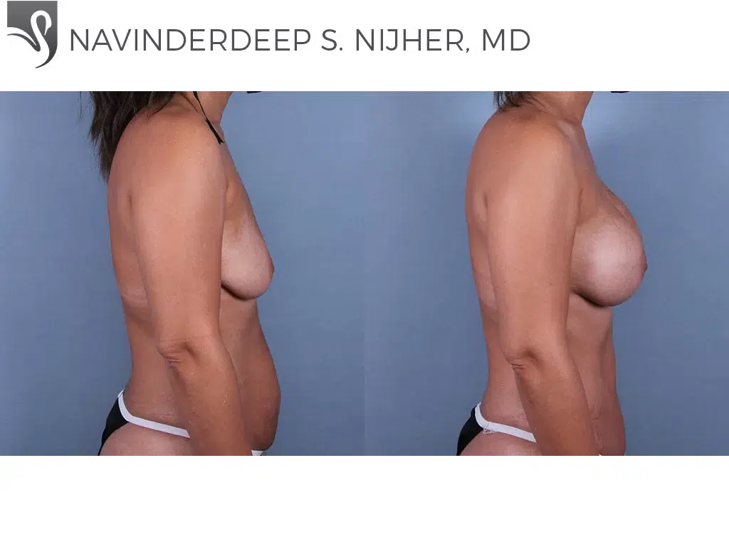 Before and After Image: Breast Augmentation Case #72961 - right-side