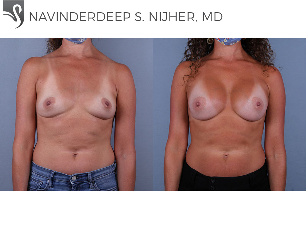 Before and After Image: Breast Augmentation Case #73301 - front
