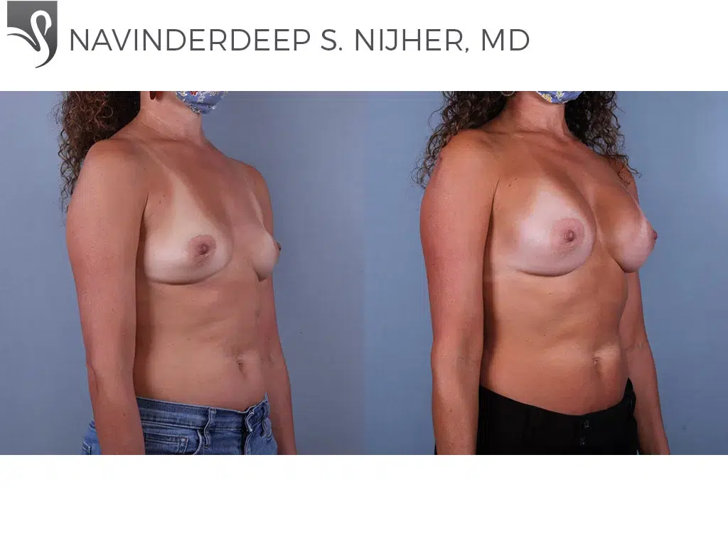 Before and After Image: Breast Augmentation Case #73301 - right-front-oblique