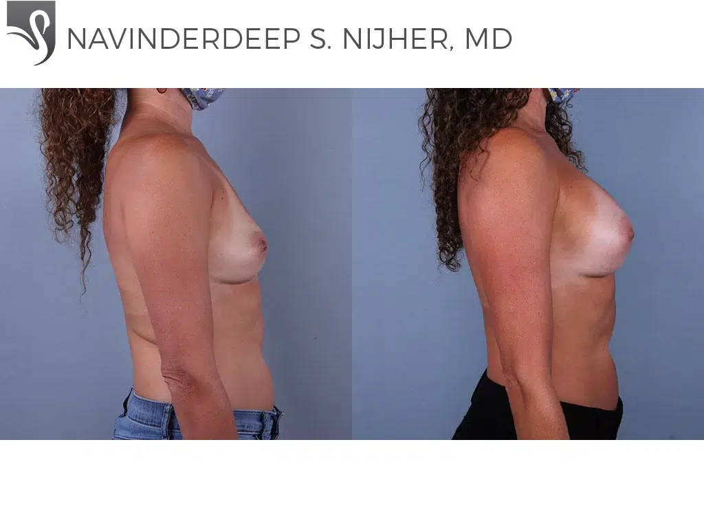 Before and After Image: Breast Augmentation Case #73301 - right-side