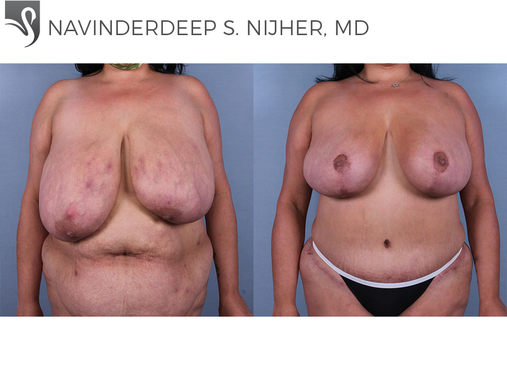 Before and After Image: Female Breast Reduction Case #73305
