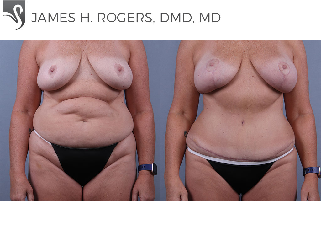 Before and After Image: Abdominoplasty (Tummy Tuck) Case #73999 - front
