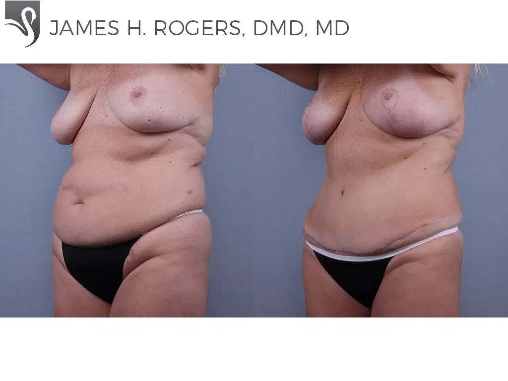 Before and After Image: Abdominoplasty (Tummy Tuck) Case #73999 - left-front-oblique