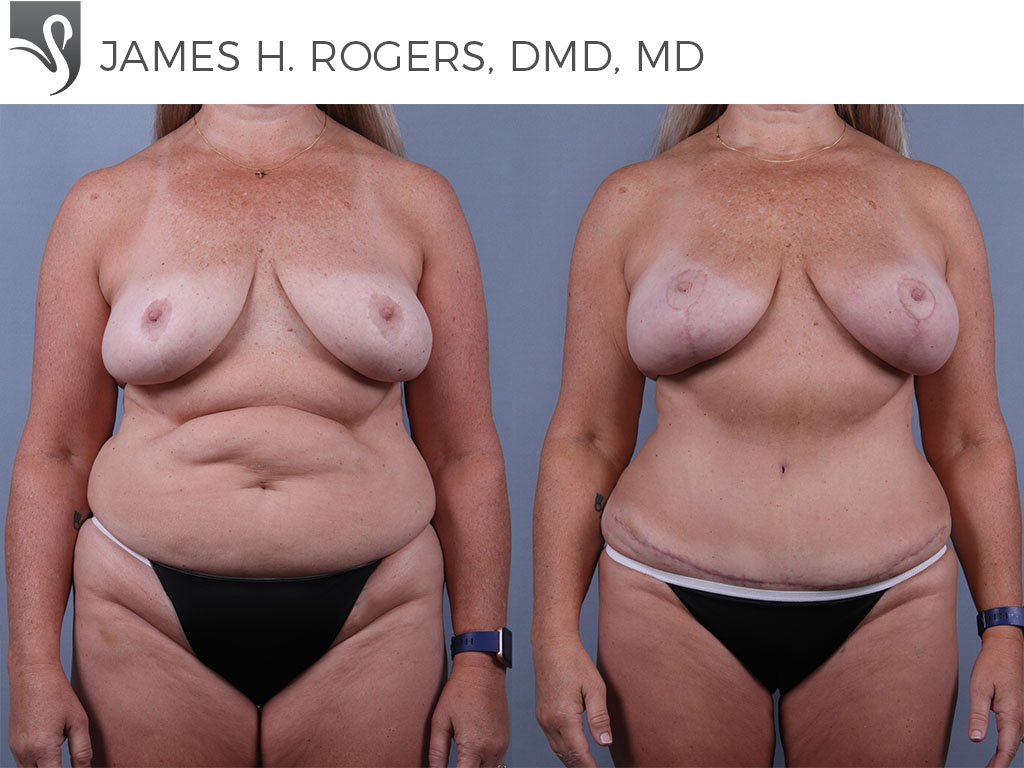 Before and After Image: Mommy Makeover Case #73999 - front