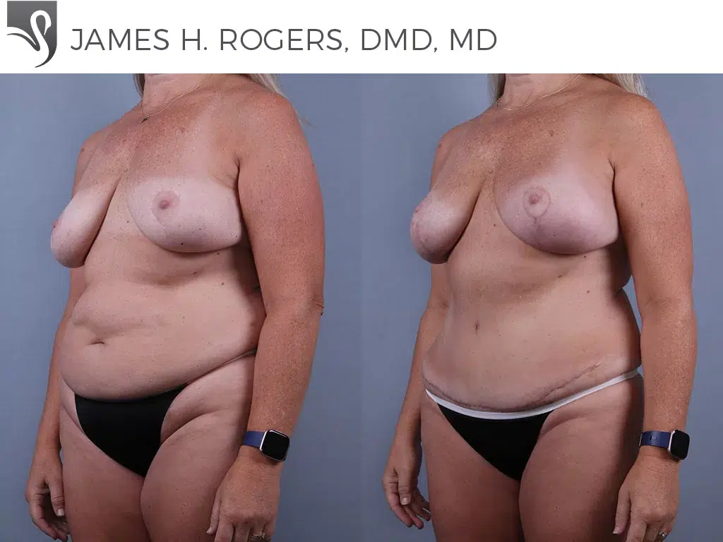 Before and After Image: Mommy Makeover Case #73999 - left-front-oblique