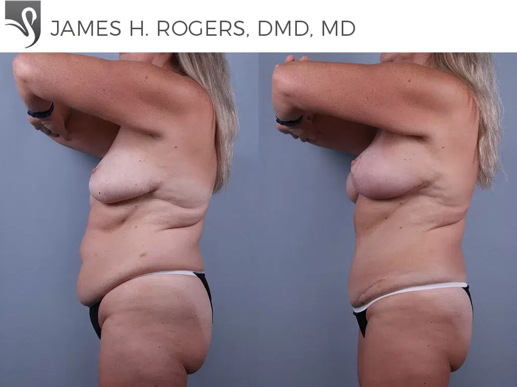 Before and After Image: Mommy Makeover Case #73999 - left-side