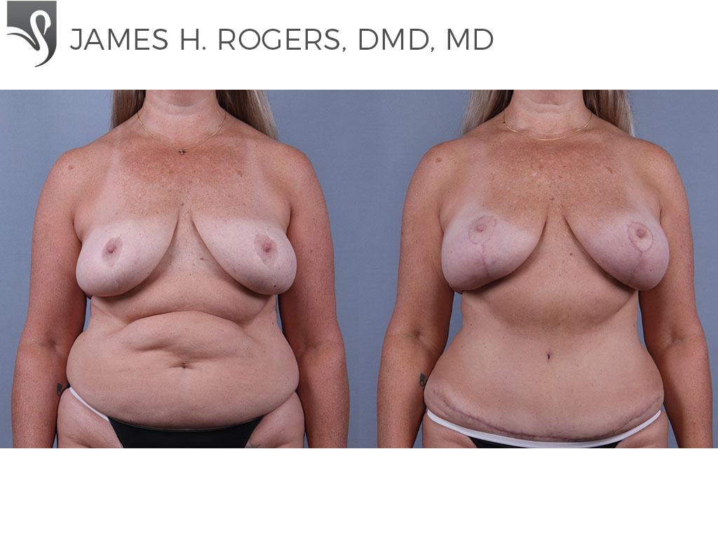 Before and After Image: Breast Lift (Mastopexy) Case #73999