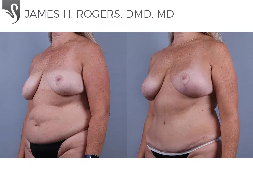 Before and After Image: Breast Lift (Mastopexy) Case #73999 - left-front-oblique