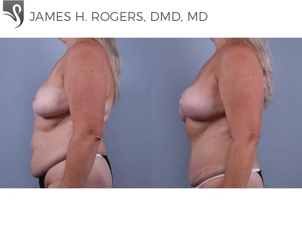 Before and After Image: Breast Lift (Mastopexy) Case #73999 - left-side