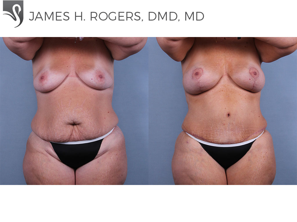 Before and After Image: Abdominoplasty (Tummy Tuck) Case #74114 - front